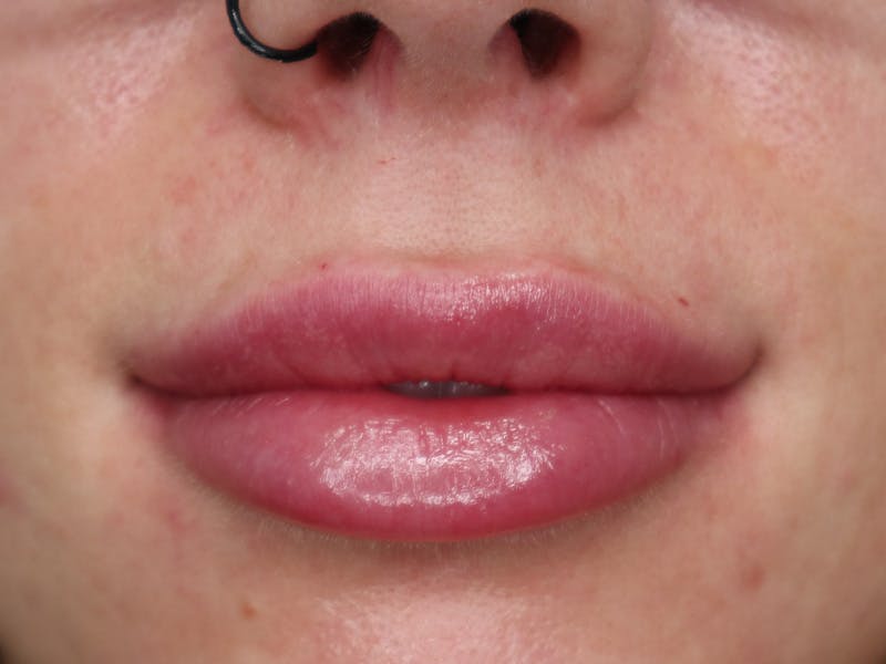 Lip Filler Before & After Gallery - Patient 87555393 - Image 2