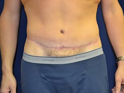 Tummy Tuck Before & After Gallery - Patient 87555398 - Image 2
