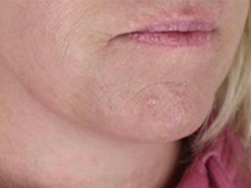 Lip Filler Before & After Gallery - Patient 87555395 - Image 1
