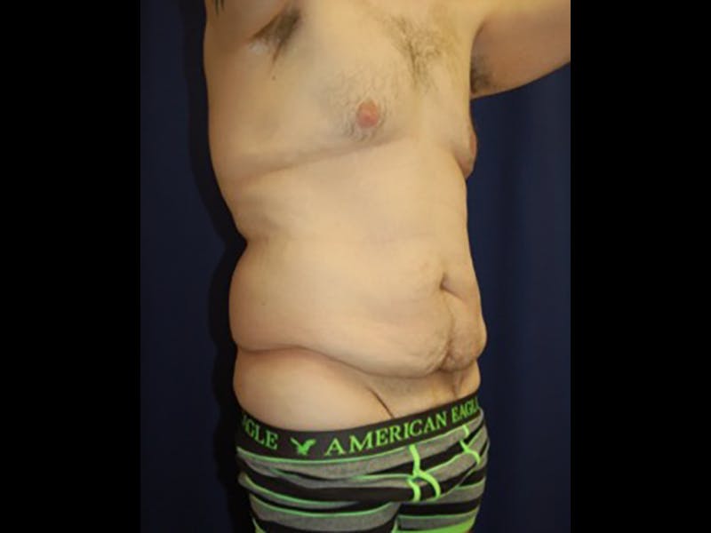 Tummy Tuck Before & After Gallery - Patient 87555398 - Image 3