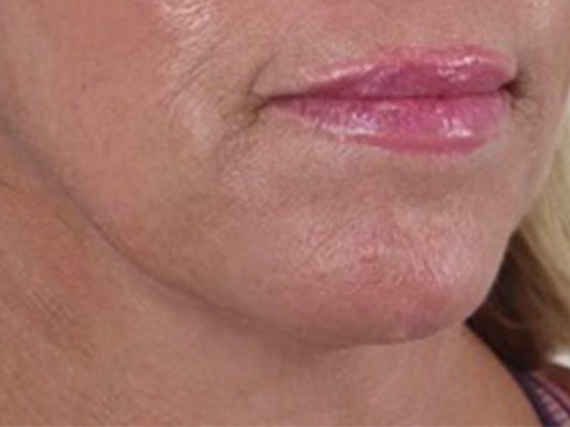 Lip Filler Before & After Gallery - Patient 87555395 - Image 2