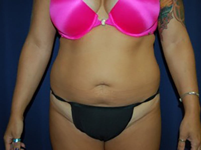 Liposuction Before & After Gallery - Patient 87555399 - Image 1