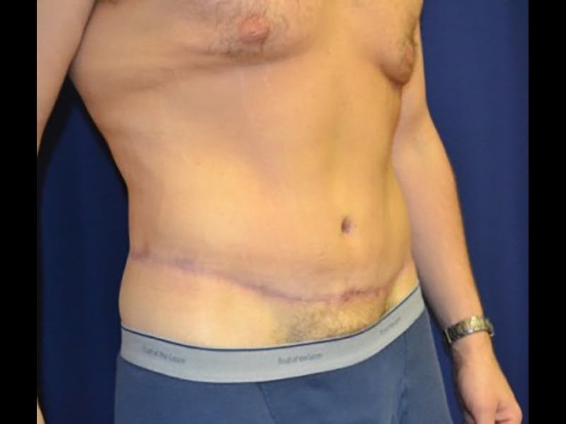 Tummy Tuck Before & After Gallery - Patient 87555398 - Image 4