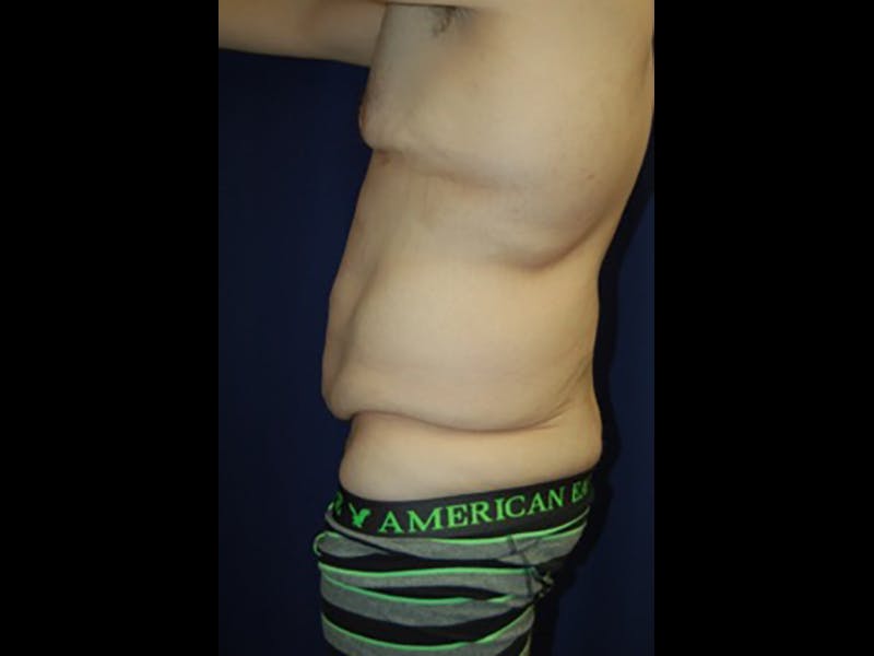 Tummy Tuck Before & After Gallery - Patient 87555398 - Image 5