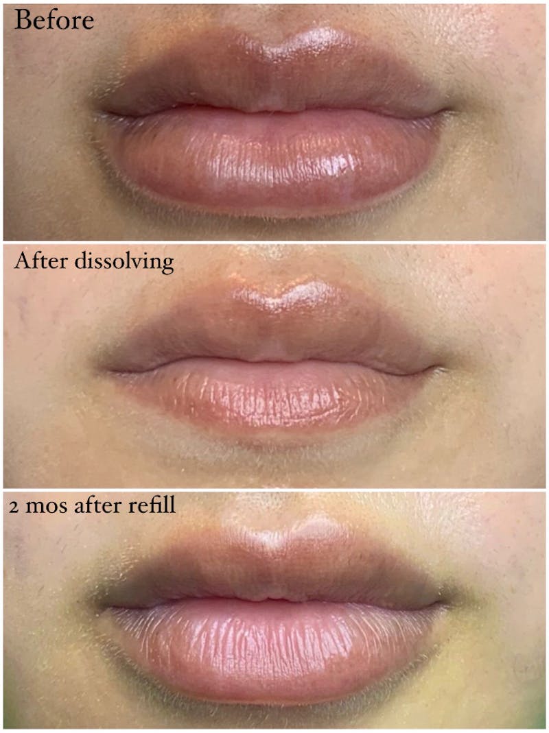 Lip Filler Before & After Gallery - Patient 87555396 - Image 2