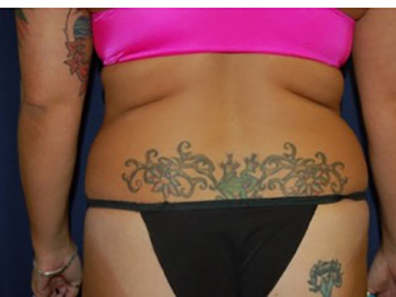 Liposuction Before & After Gallery - Patient 87555399 - Image 3