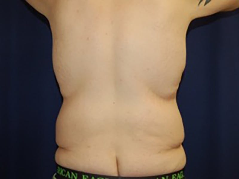 Tummy Tuck Before & After Gallery - Patient 87555398 - Image 7