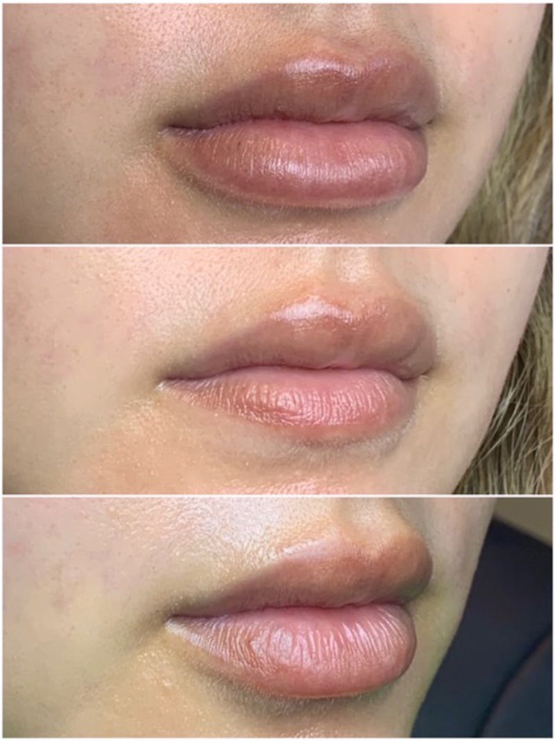 Lip Filler Before & After Gallery - Patient 87555396 - Image 4