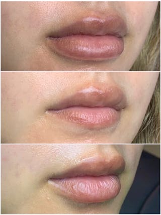 Lip Filler Before & After Gallery - Patient 87555396 - Image 4