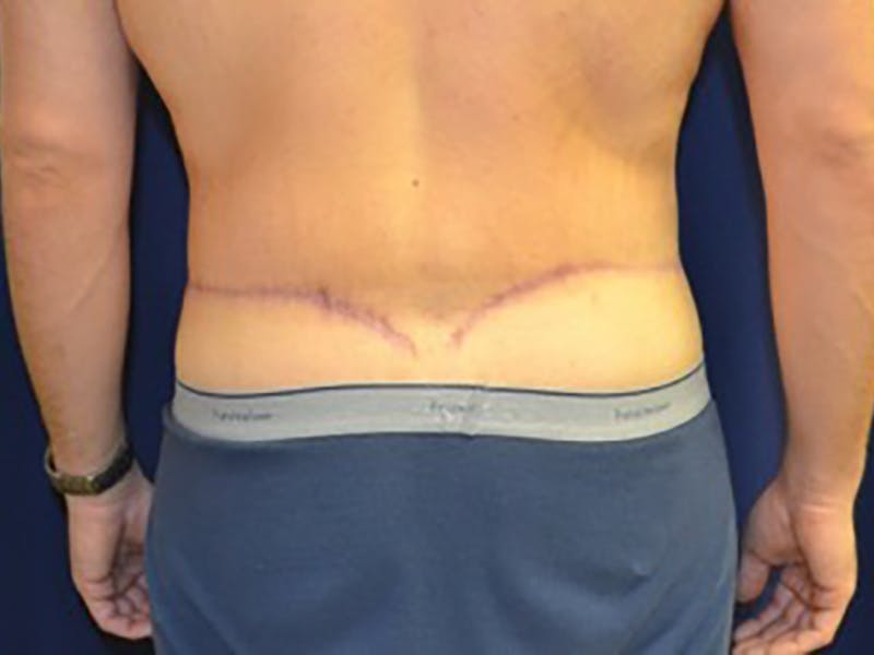 Tummy Tuck Before & After Gallery - Patient 87555398 - Image 8