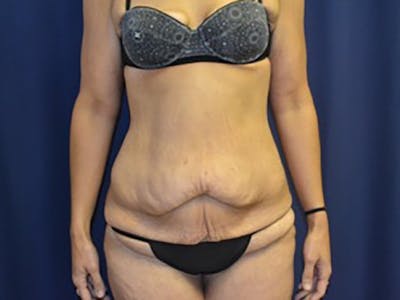 Tummy Tuck Before & After Gallery - Patient 87555400 - Image 1