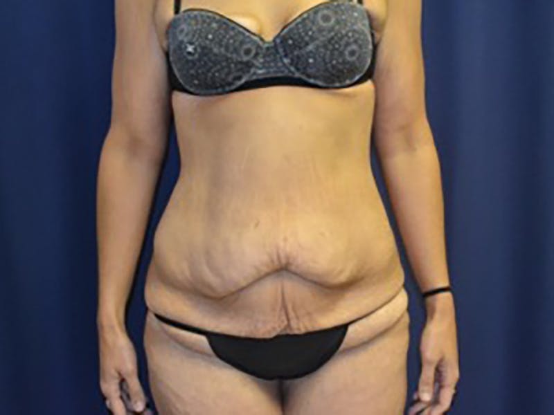 Tummy Tuck Before & After Gallery - Patient 87555400 - Image 1