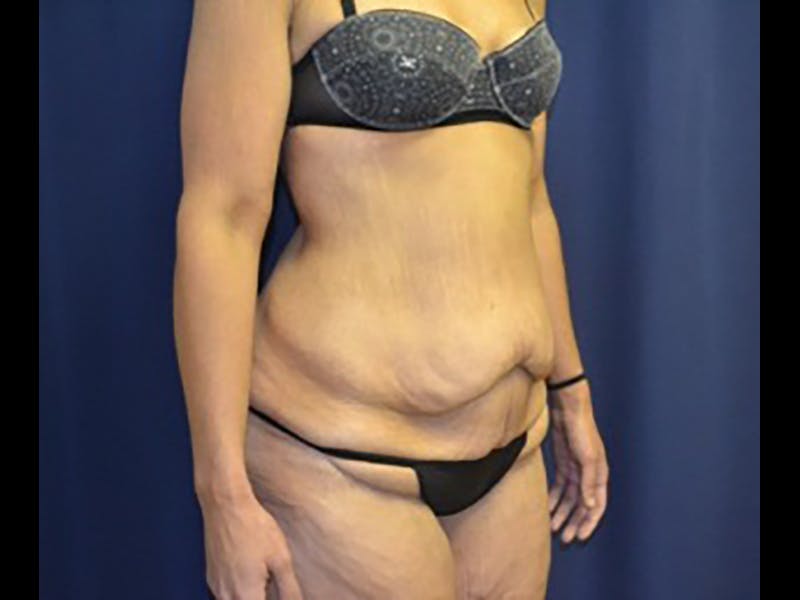 Tummy Tuck Before & After Gallery - Patient 87555400 - Image 3