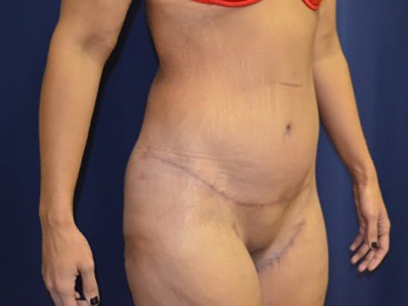 Tummy Tuck Before & After Gallery - Patient 87555400 - Image 4