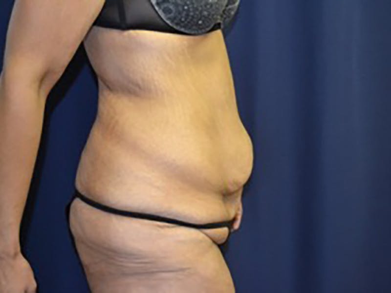 Tummy Tuck Before & After Gallery - Patient 87555400 - Image 5