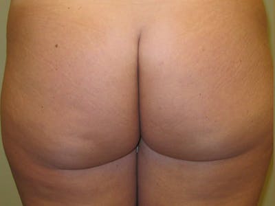 Liposuction Before & After Gallery - Patient 87555401 - Image 1