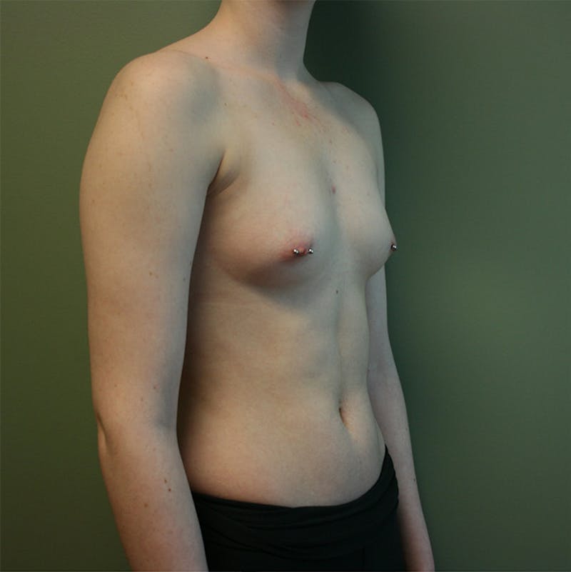 Breast Augmentation Before & After Gallery - Patient 87555402 - Image 1