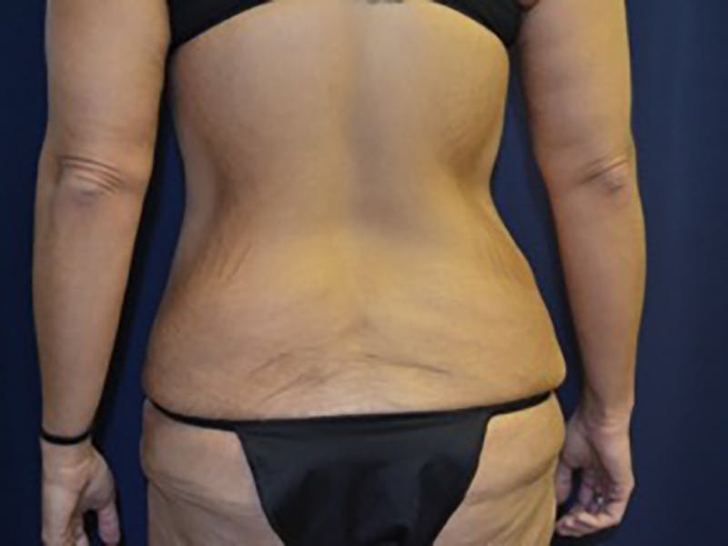 Tummy Tuck Before & After Gallery - Patient 87555400 - Image 7
