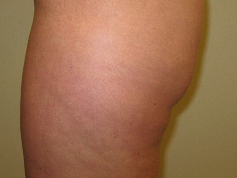 Liposuction Before & After Gallery - Patient 87555401 - Image 3