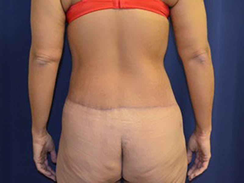 Tummy Tuck Before & After Gallery - Patient 87555400 - Image 8