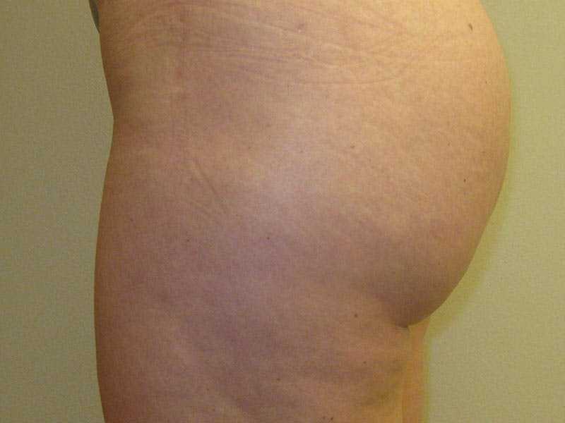 Liposuction Before & After Gallery - Patient 87555401 - Image 4