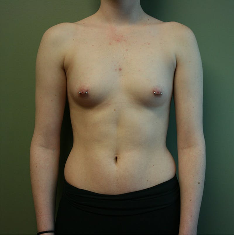 Breast Augmentation Before & After Gallery - Patient 87555402 - Image 3
