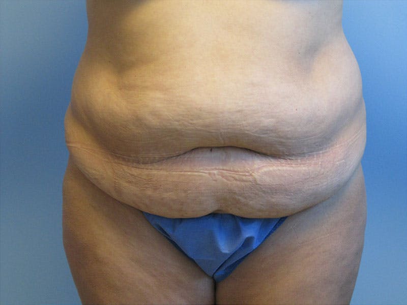 Tummy Tuck Before & After Gallery - Patient 87555403 - Image 1