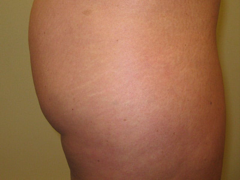 Liposuction Before & After Gallery - Patient 87555401 - Image 5