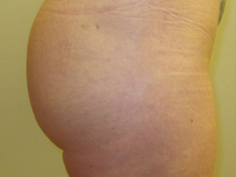 Liposuction Before & After Gallery - Patient 87555401 - Image 6