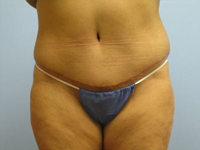 Tummy Tuck Before & After Gallery - Patient 87555403 - Image 2