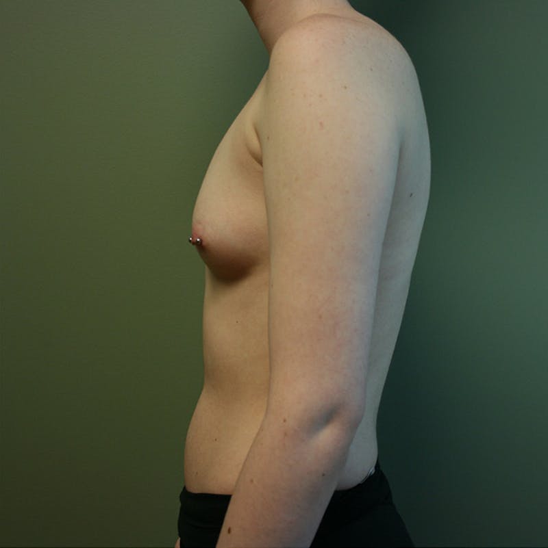 Breast Augmentation Before & After Gallery - Patient 87555402 - Image 5