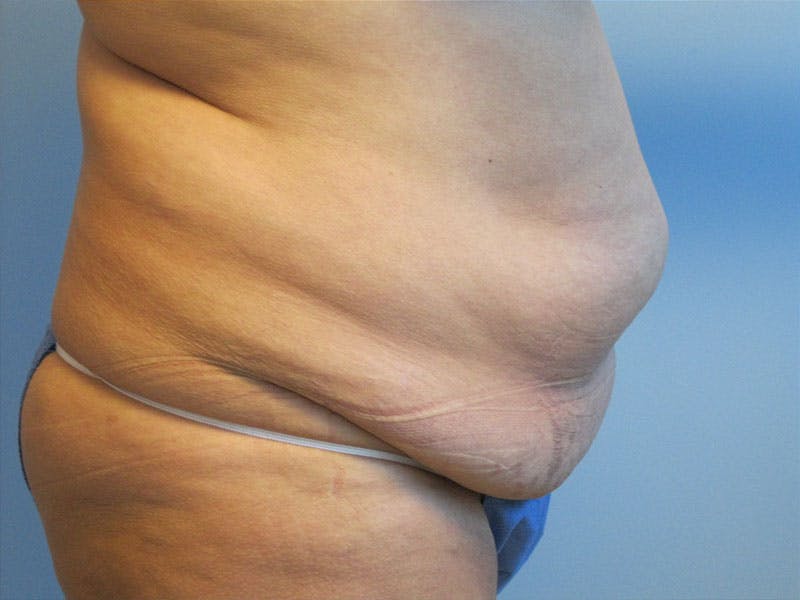 Tummy Tuck Before & After Gallery - Patient 87555403 - Image 3