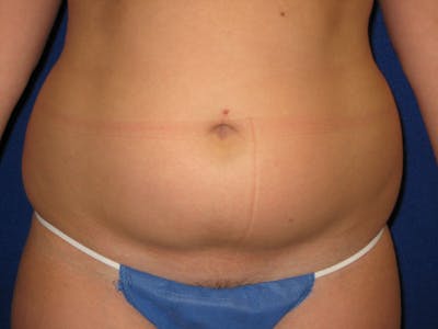 Liposuction Before & After Gallery - Patient 87555405 - Image 1
