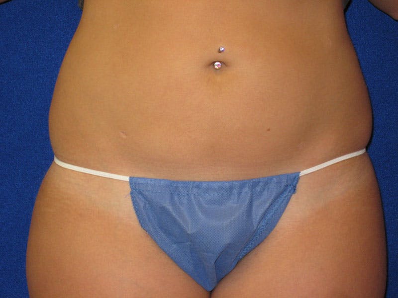Liposuction Before & After Gallery - Patient 87555405 - Image 2