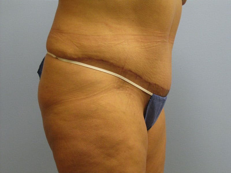 Tummy Tuck Before & After Gallery - Patient 87555403 - Image 4