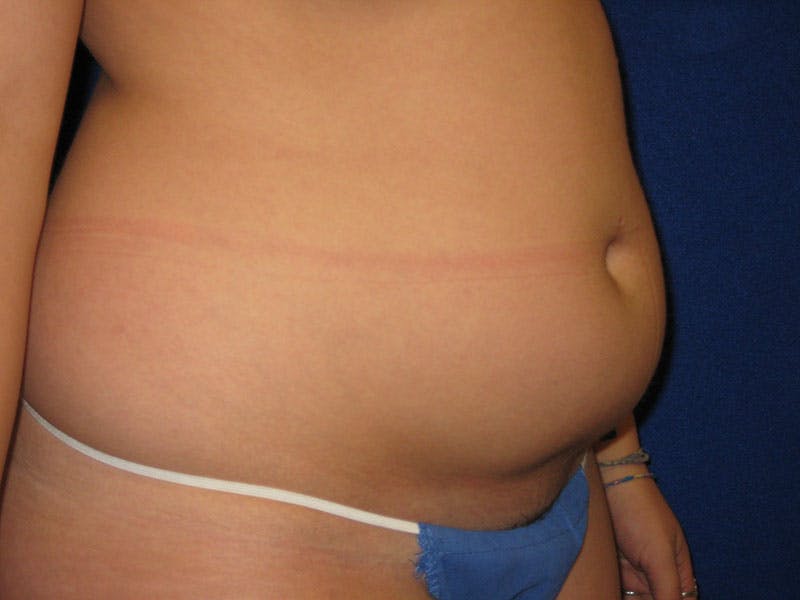 Liposuction Before & After Gallery - Patient 87555405 - Image 3
