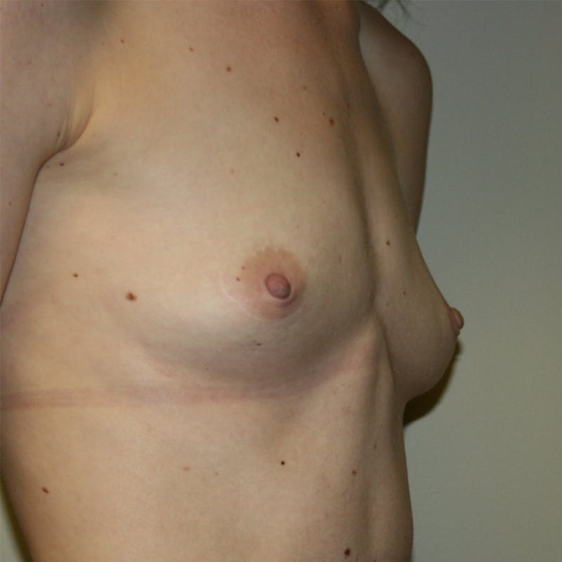Breast Augmentation Before & After Gallery - Patient 87555408 - Image 1