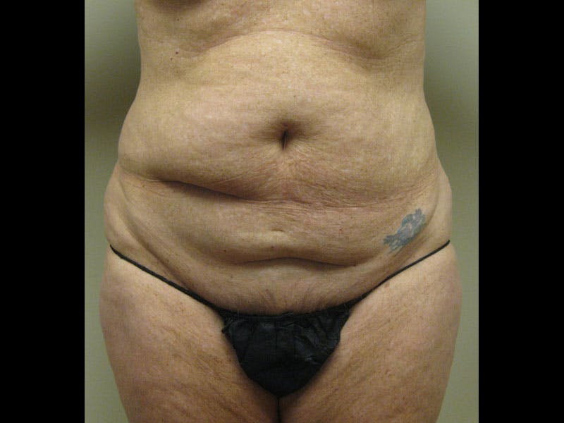Tummy Tuck Before & After Gallery - Patient 87555407 - Image 1