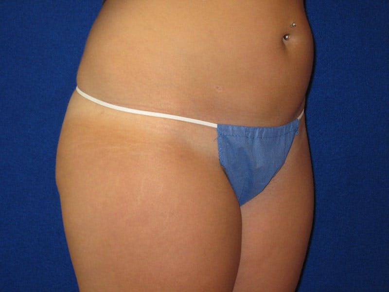 Liposuction Before & After Gallery - Patient 87555405 - Image 4