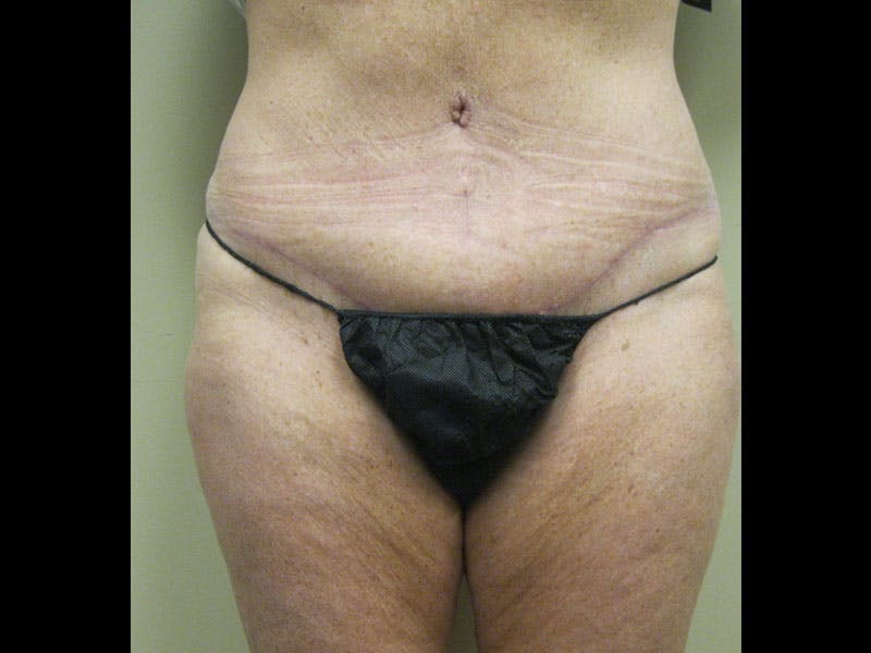 Tummy Tuck Before & After Gallery - Patient 87555407 - Image 2