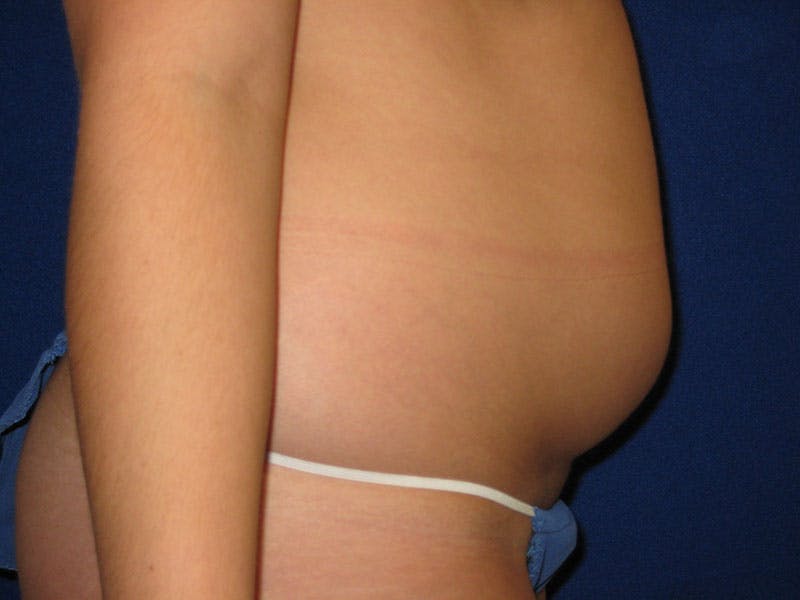 Liposuction Before & After Gallery - Patient 87555405 - Image 5