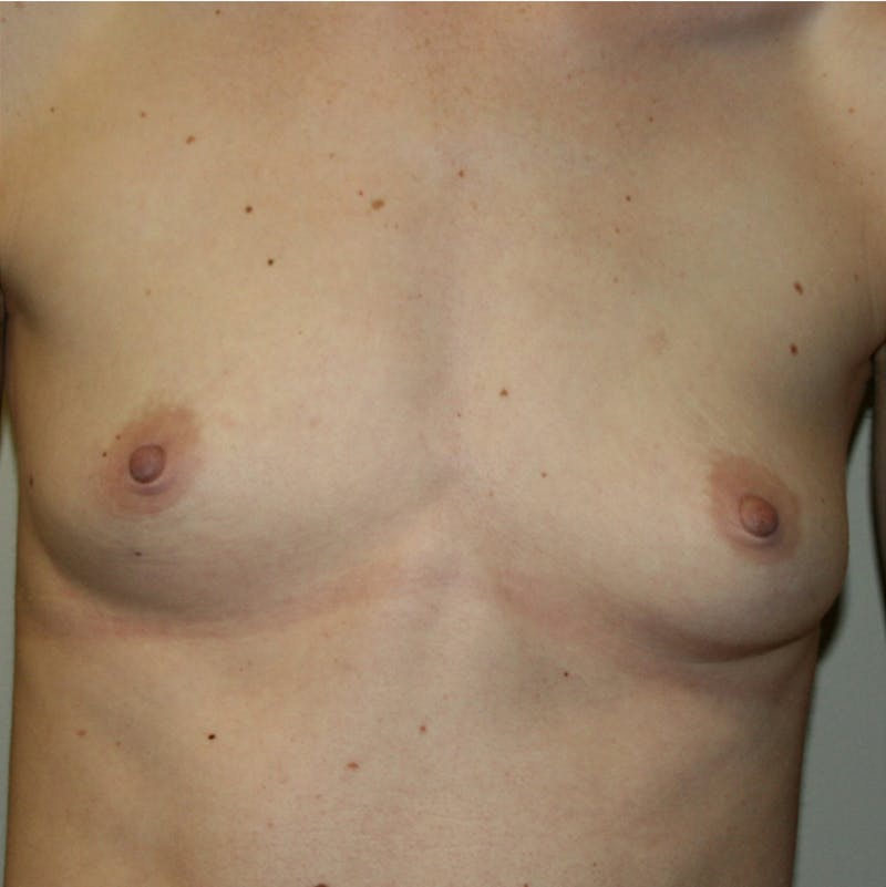 Breast Augmentation Before & After Gallery - Patient 87555408 - Image 3