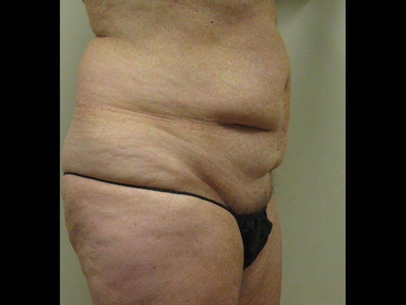 Tummy Tuck Before & After Gallery - Patient 87555407 - Image 3