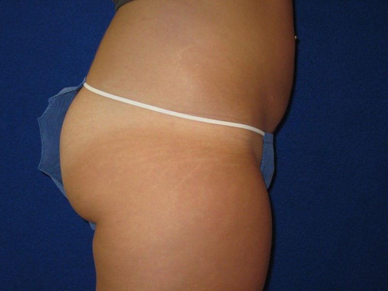 Liposuction Before & After Gallery - Patient 87555405 - Image 6