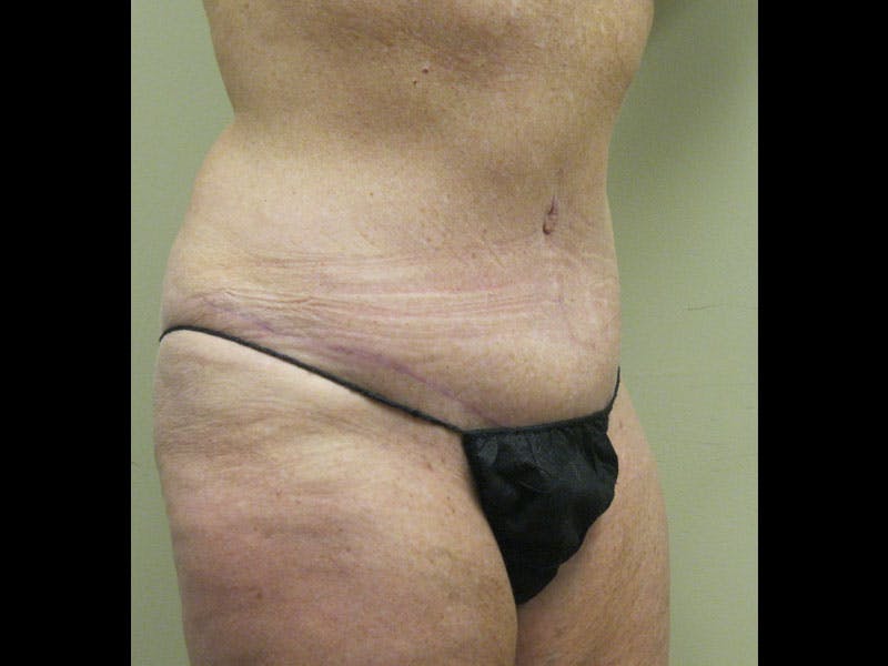 Tummy Tuck Before & After Gallery - Patient 87555407 - Image 4