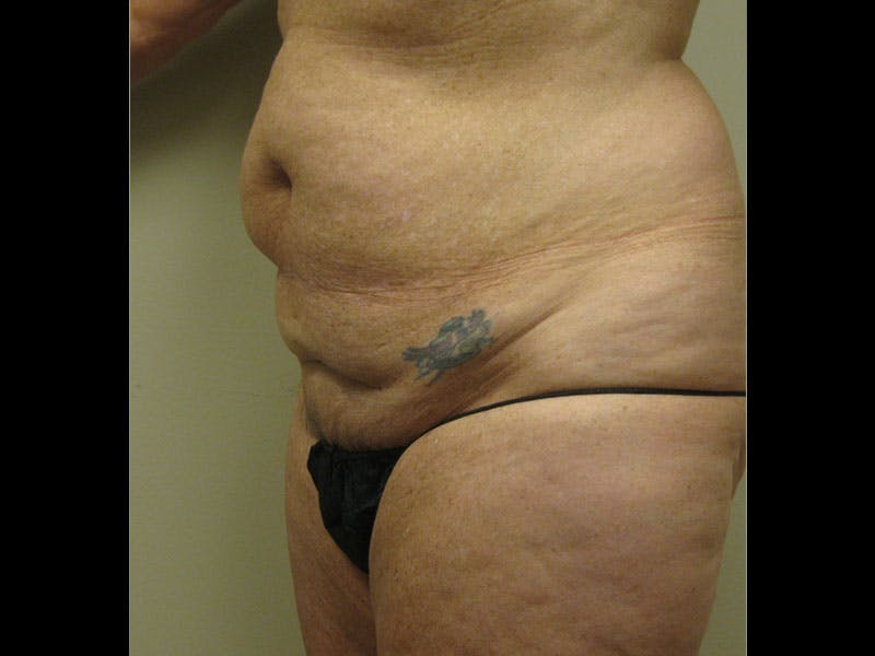 Tummy Tuck Before & After Gallery - Patient 87555407 - Image 5