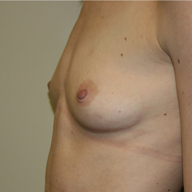 Breast Augmentation Before & After Gallery - Patient 87555408 - Image 5