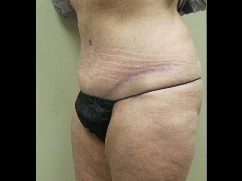 Tummy Tuck Before & After Gallery - Patient 87555407 - Image 6