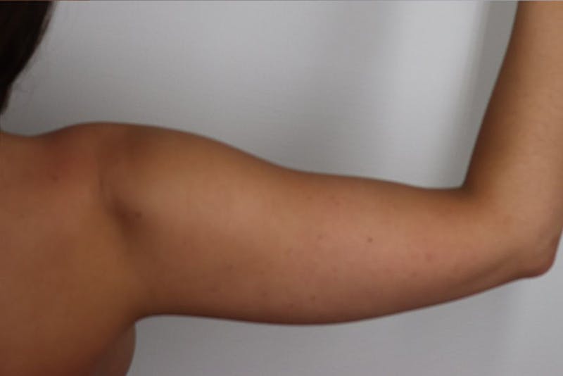 Liposuction Before & After Gallery - Patient 87555406 - Image 2
