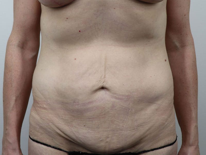 Tummy Tuck Before & After Gallery - Patient 87555410 - Image 1